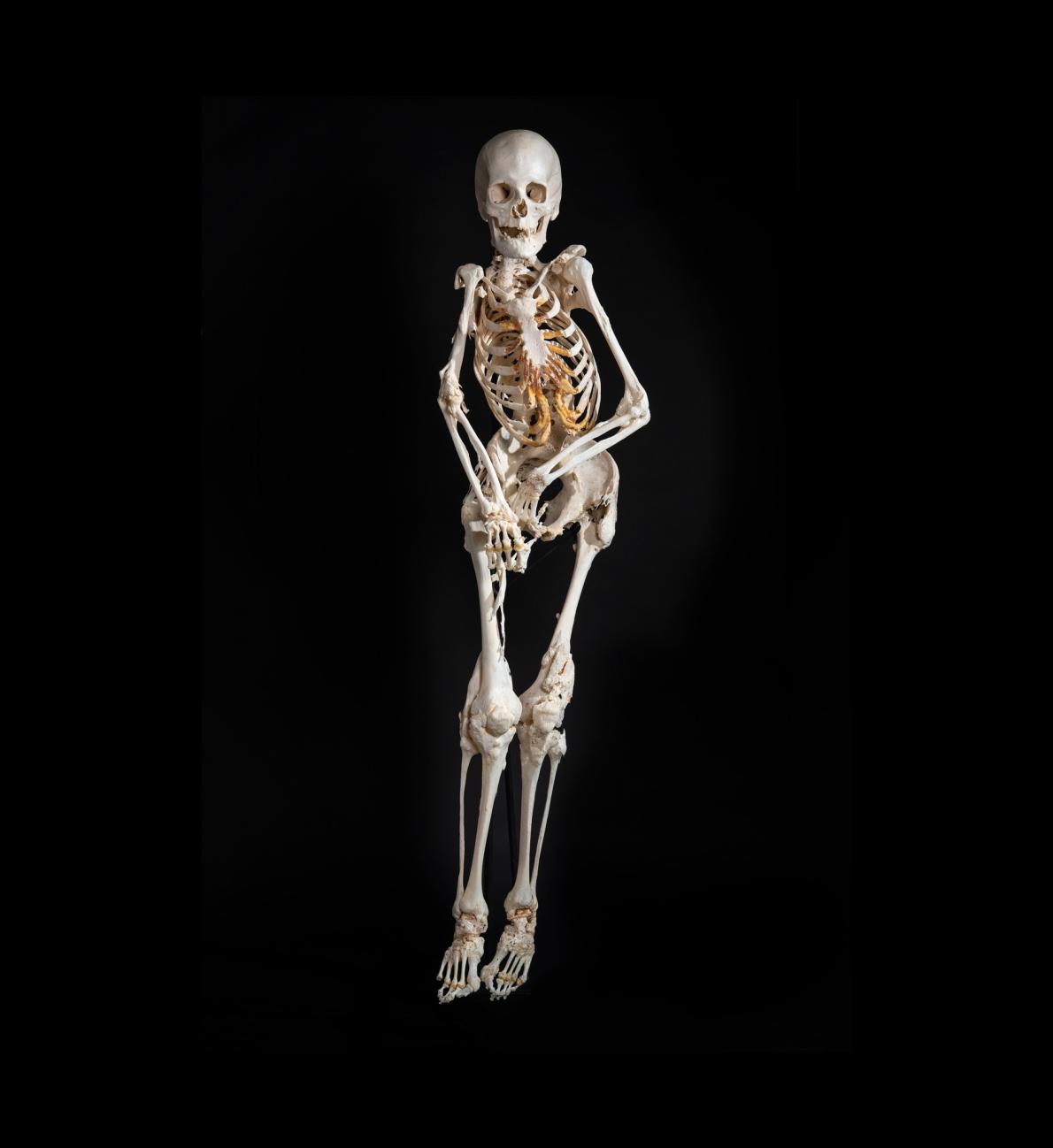 ギャラリー 骨の難病と闘った女性 願い叶い博物館の展示に 写真4点 ナショナルジオグラフィック日本版サイト