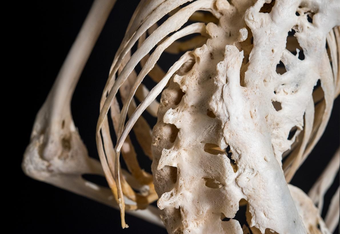 Рак костей фото скелета Рак костей фото скелета