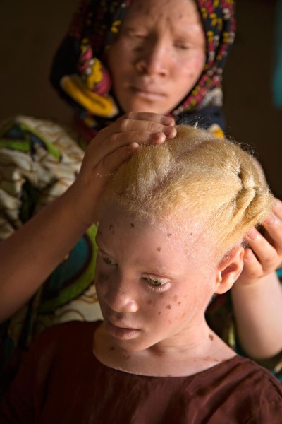 国際アルビニズム啓発デー が作られた理由 ナショナルジオグラフィック日本版サイト 国際アルビニズム啓発デー が作られた理由 ナショナルジオグラフィック日本版サイト