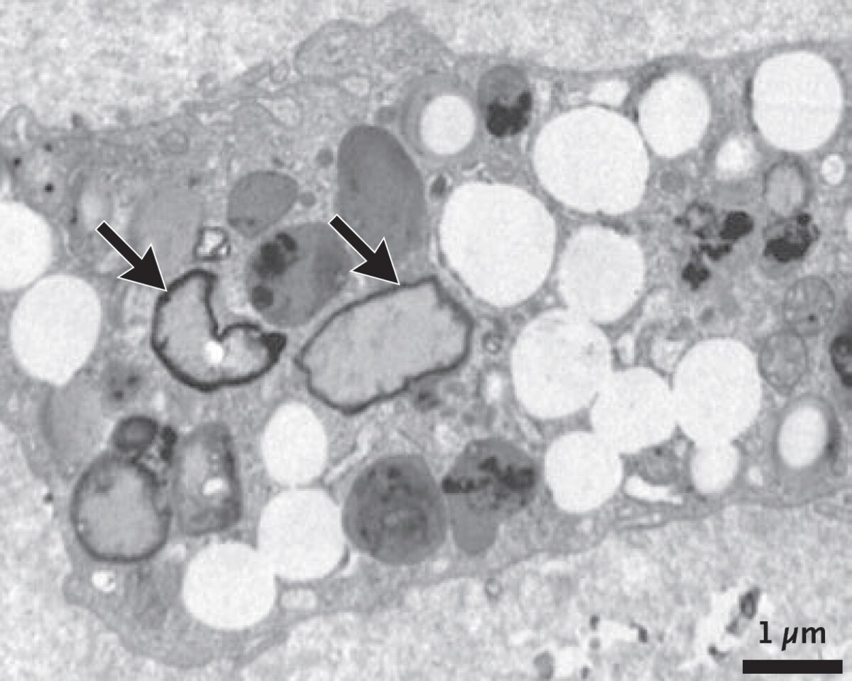 患者のマクロファージ細胞内（左）と頸動脈から除去されたプラーク内（右）で検出されたマイクロプラスチック粒子の顕微鏡画像。矢印が指し示すギザギザしたものがマイクロプラスチック粒子。（MICROGRAPH BY MARFELLA, ET AL., 2024 (LEFT) AND MICROGRAPH BY MARFELLA, ET AL., 2024 (RIGHT)）