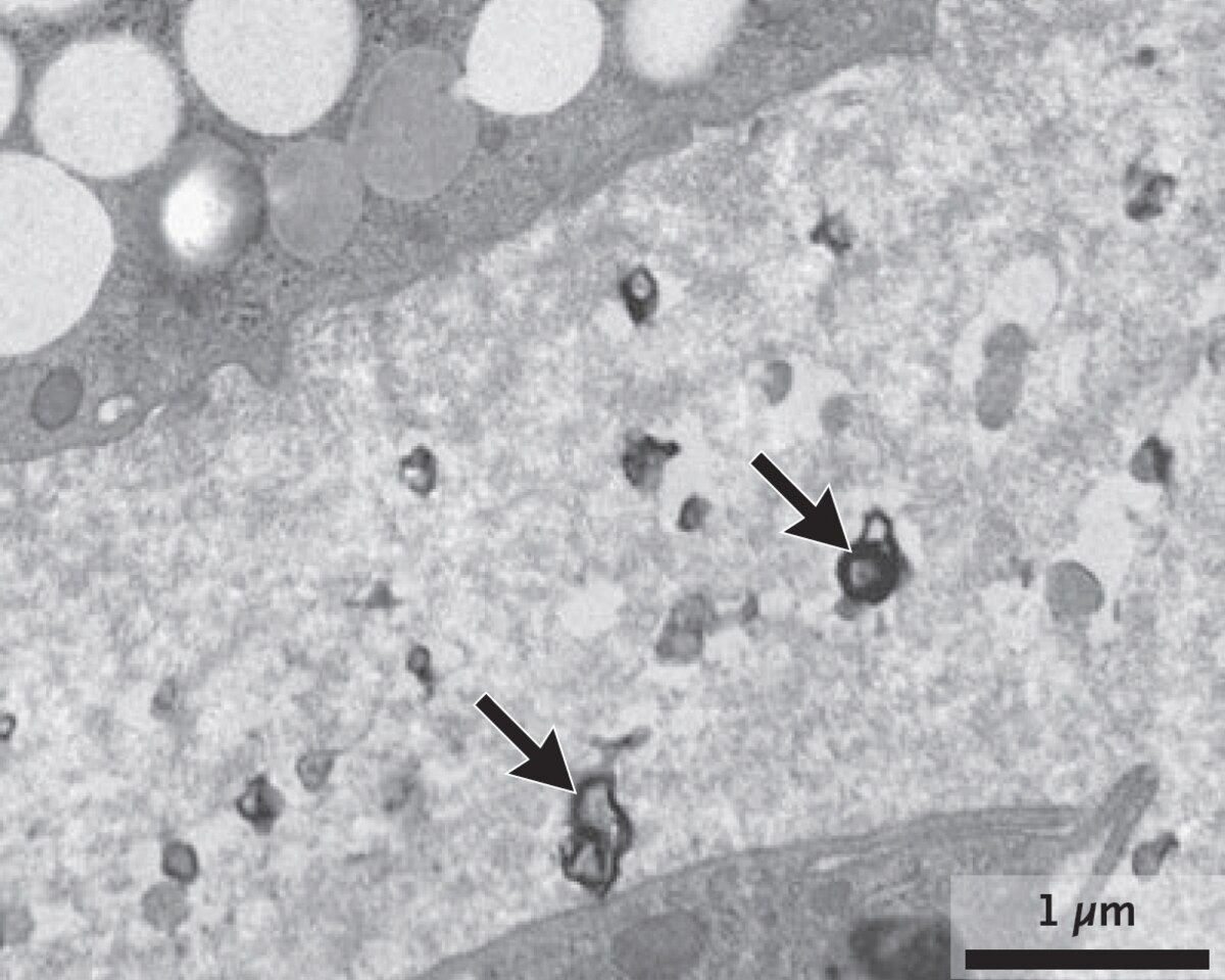 患者のマクロファージ細胞内（左）と頸動脈から除去されたプラーク内（右）で検出されたマイクロプラスチック粒子の顕微鏡画像。矢印が指し示すギザギザしたものがマイクロプラスチック粒子。（MICROGRAPH BY MARFELLA, ET AL., 2024 (LEFT) AND MICROGRAPH BY MARFELLA, ET AL., 2024 (RIGHT)）