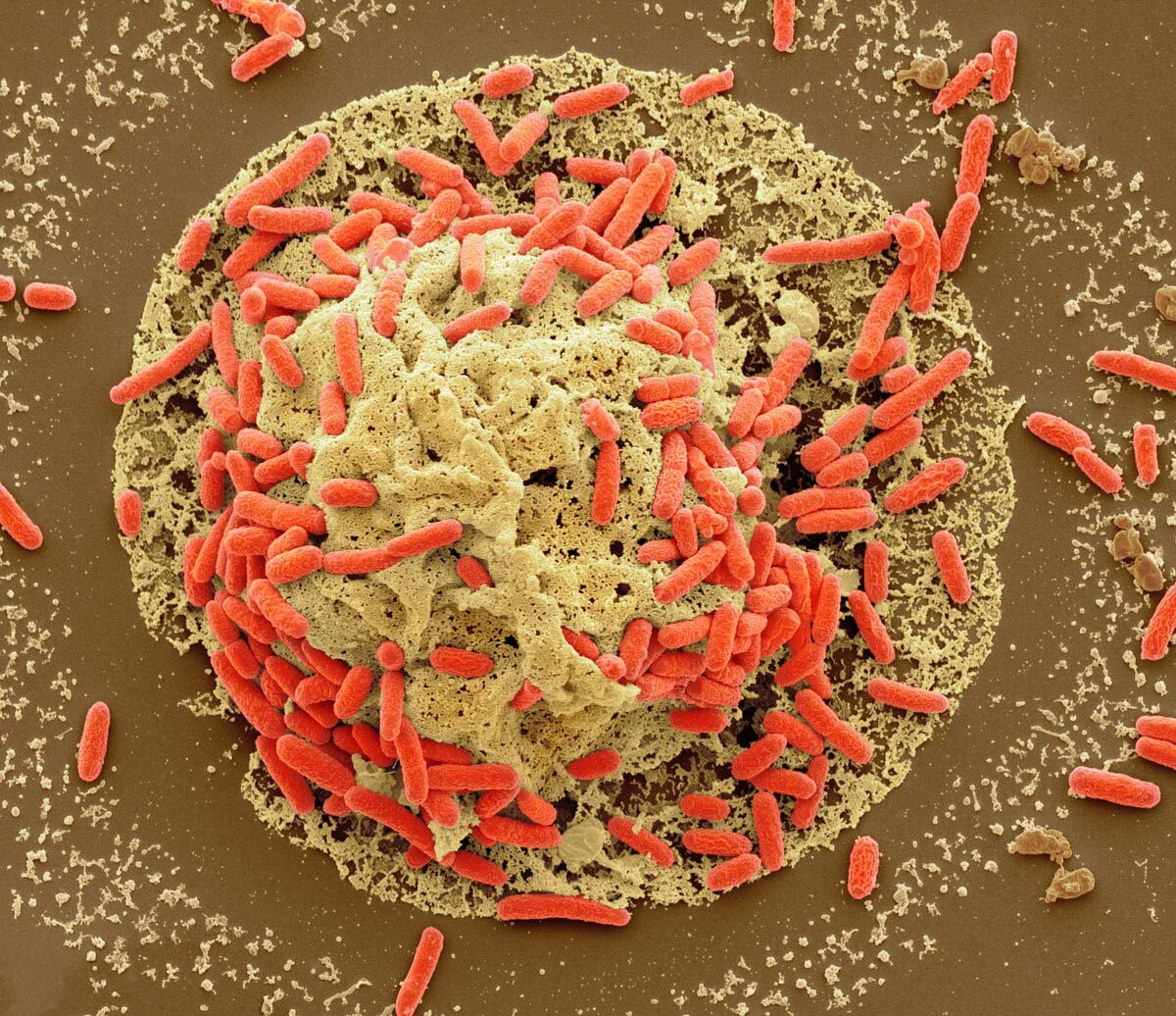 急増する若い世代の大腸がん、子供の頃の腸内細菌が関連か、研究