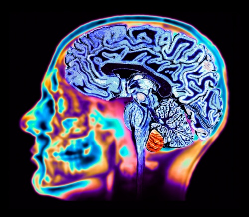 長年にわたり、リチウムは双極性障害(躁うつ病)の標準的な治療に使われてきたが、近年の研究では、リチウム不足がアルツハイマー病の一因となる可能性が示されている。(Composite Image by Zephyr/Science Photo Library)